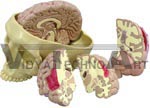 Diseased Brain in Skull Model